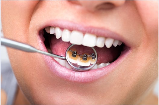 LINGUAL BRACES
