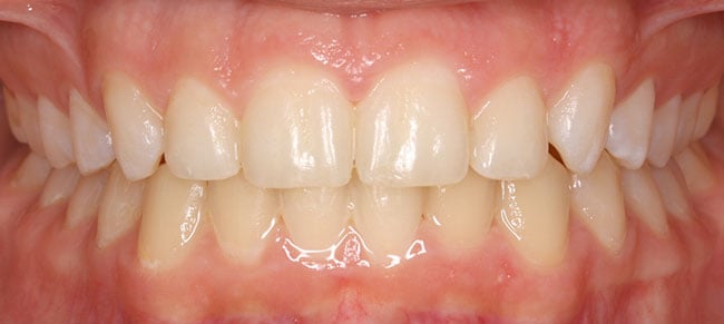 After Treatment