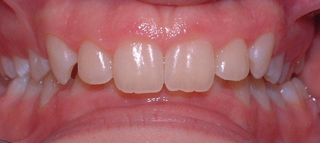 Before Treatment