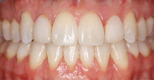 After Treatment