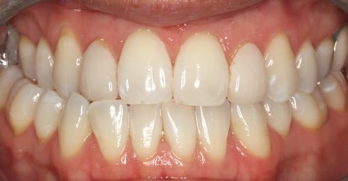 Before Treatment