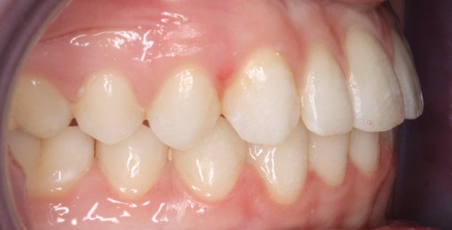 After Treatment