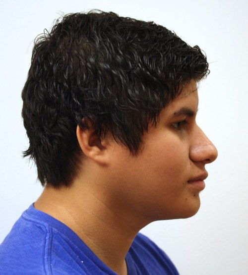 After Treatment