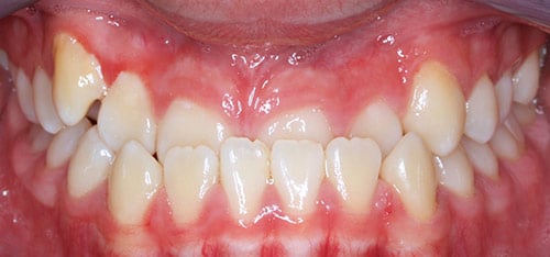 Before Treatment