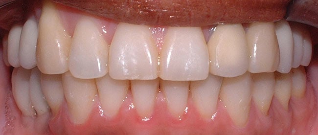 After Treatment