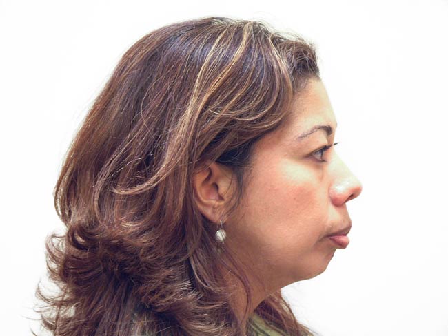 Before Treatment