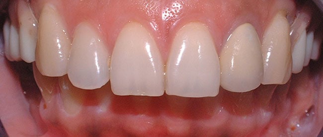 Before Treatment