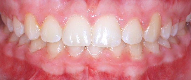 After Treatment