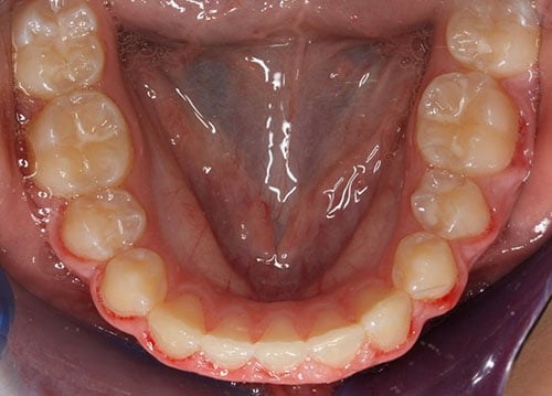 After Treatment