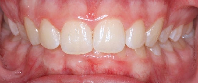 Before Treatment