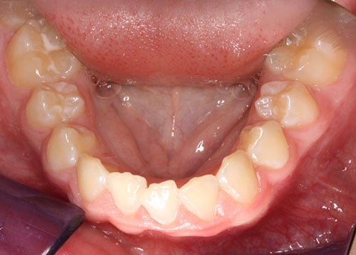 Before Treatment