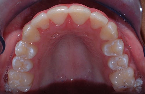 After Treatment