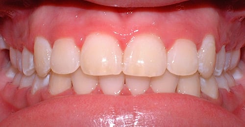 After Treatment