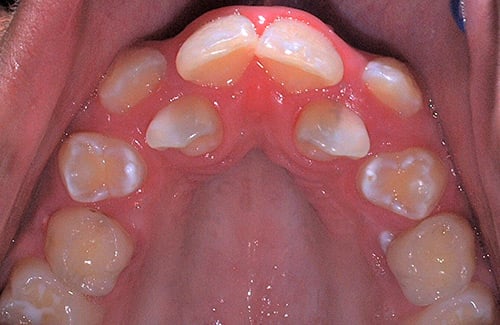 Before Treatment