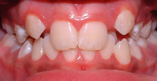 Before Treatment