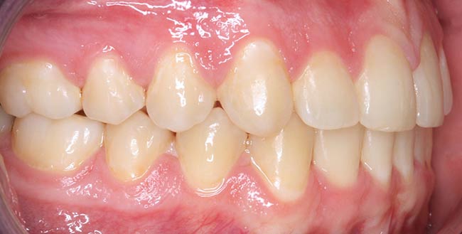 After Treatment