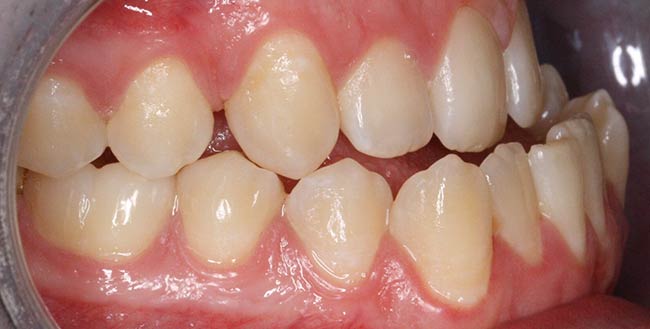 Before Treatment