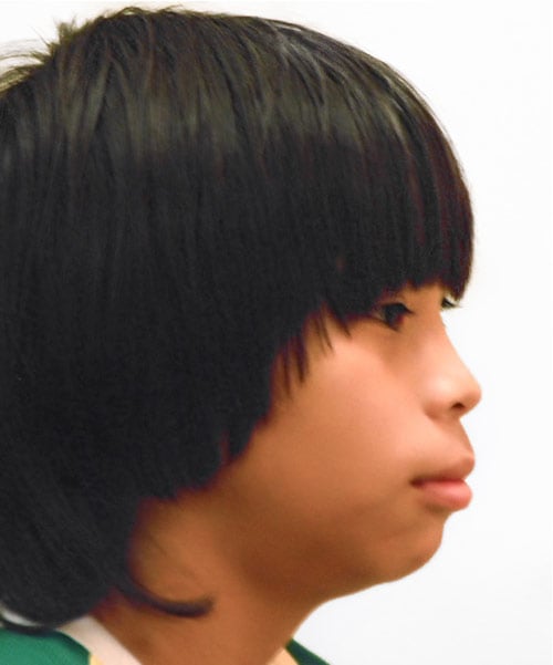 Before Treatment