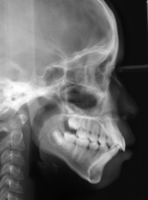 Before Treatment