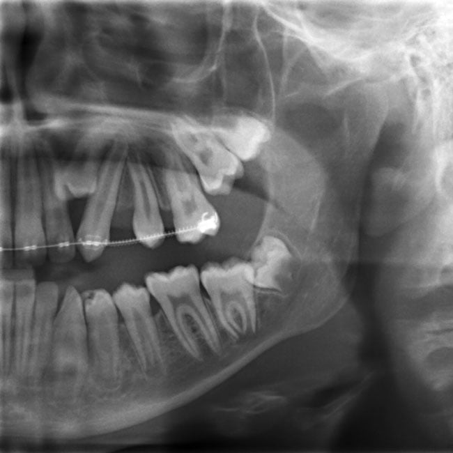 Before Treatment