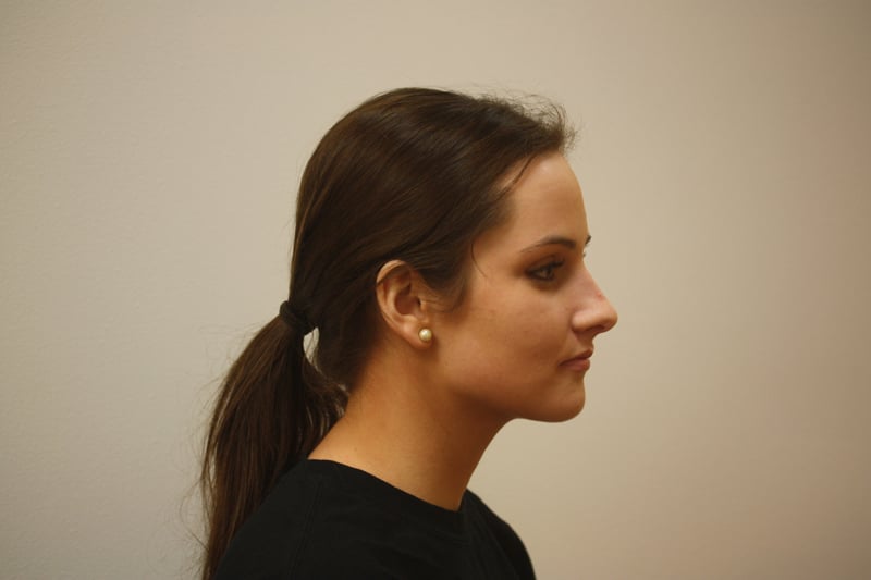 After Treatment