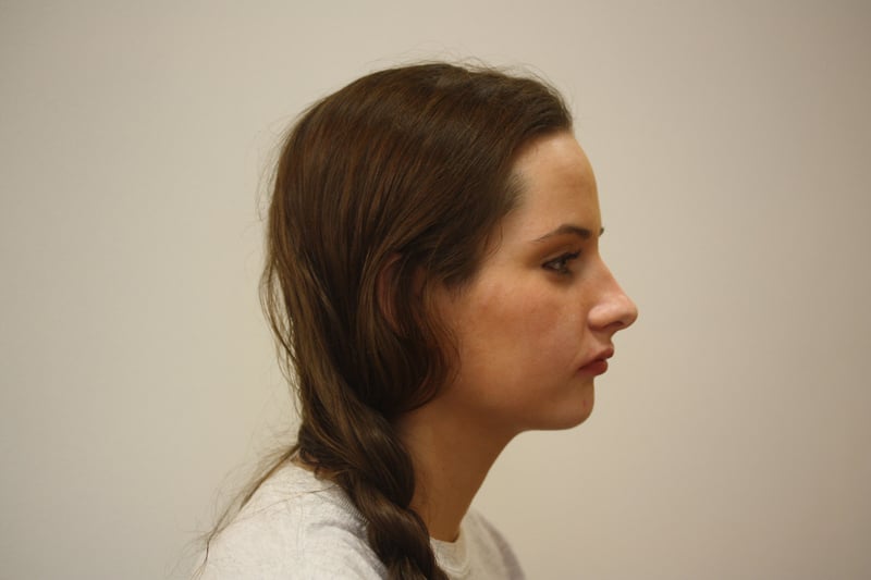 Before Treatment