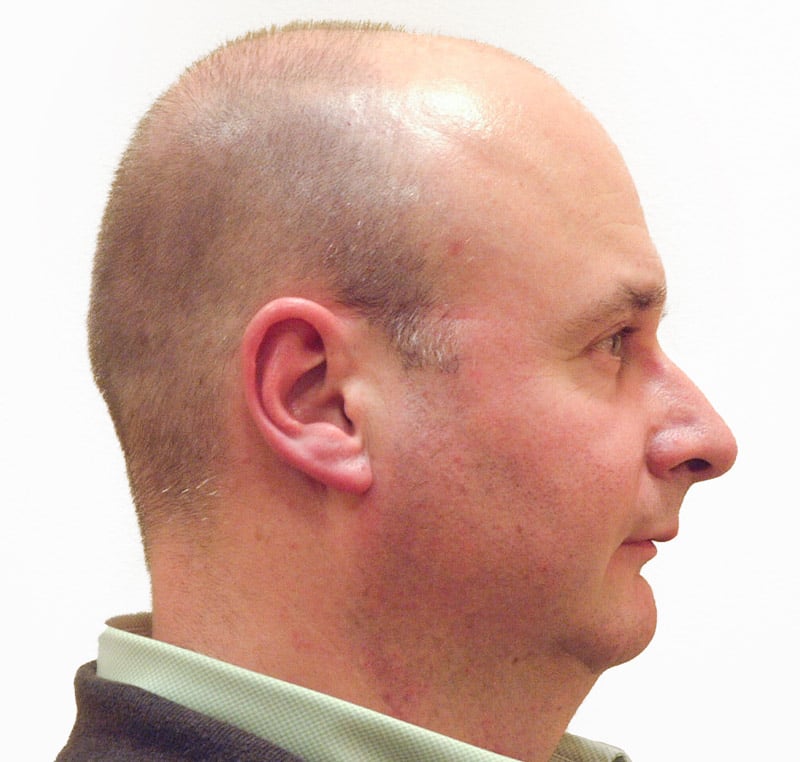 Before Treatment