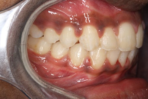 After Treatment