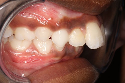 Before Treatment