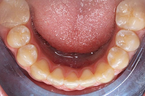 After Treatment