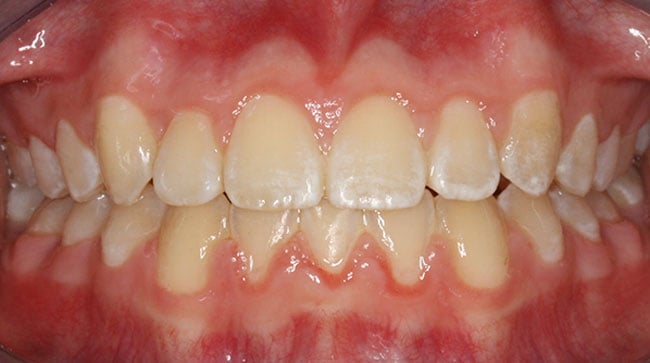 After Treatment