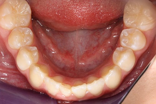 Before Treatment