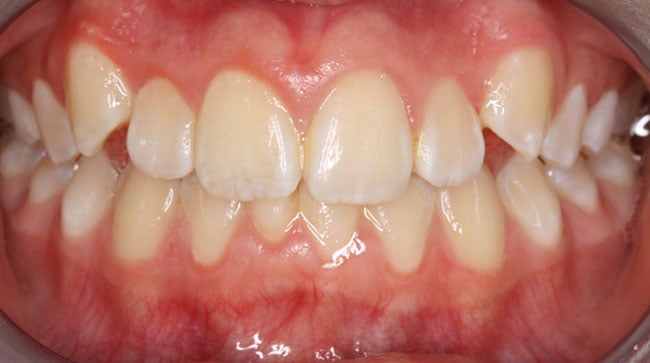 Before Treatment