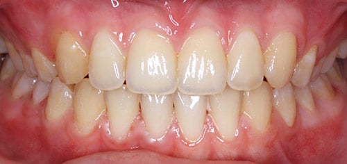 After Treatment