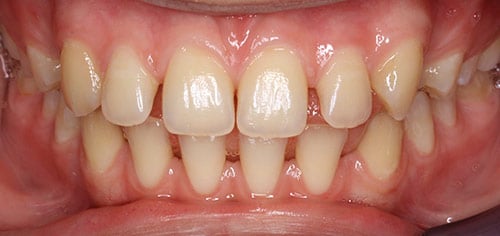 Before Treatment