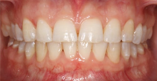 After Treatment