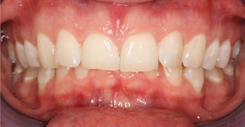 Before Treatment