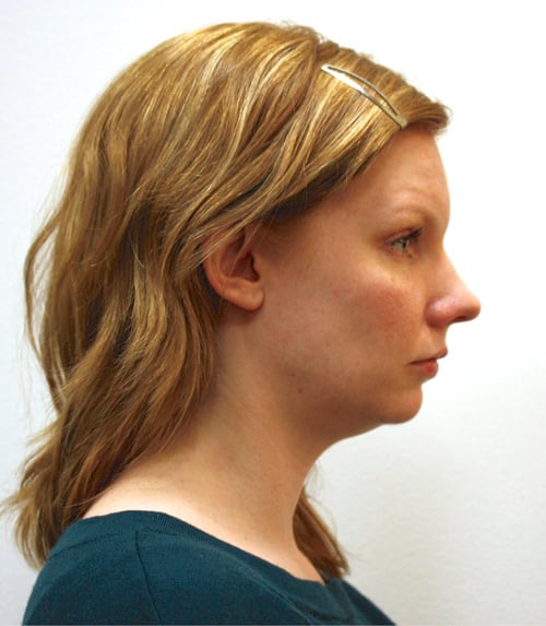 Before Treatment