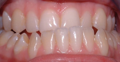 Before Treatment