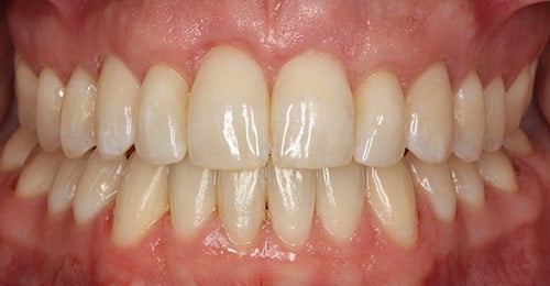After Treatment
