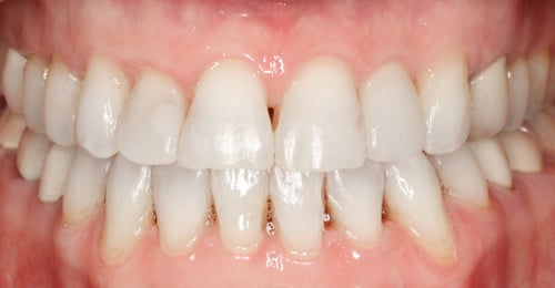 After Treatment