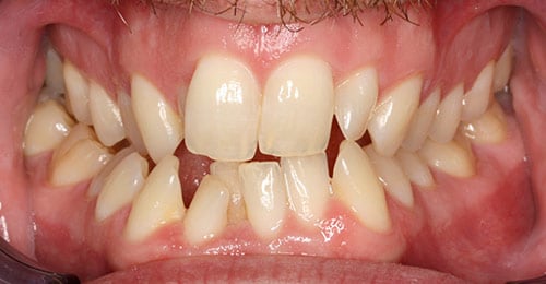 Before Treatment