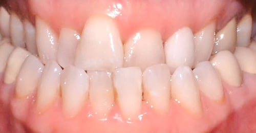 Before Treatment