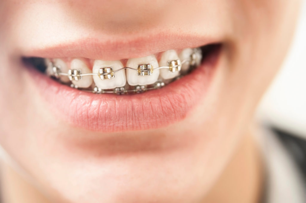 Close up of teen boy's small with braces
