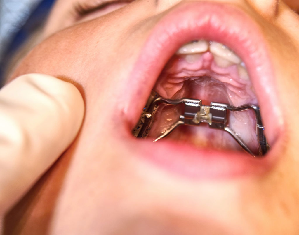 Kid wearing a palatal expander