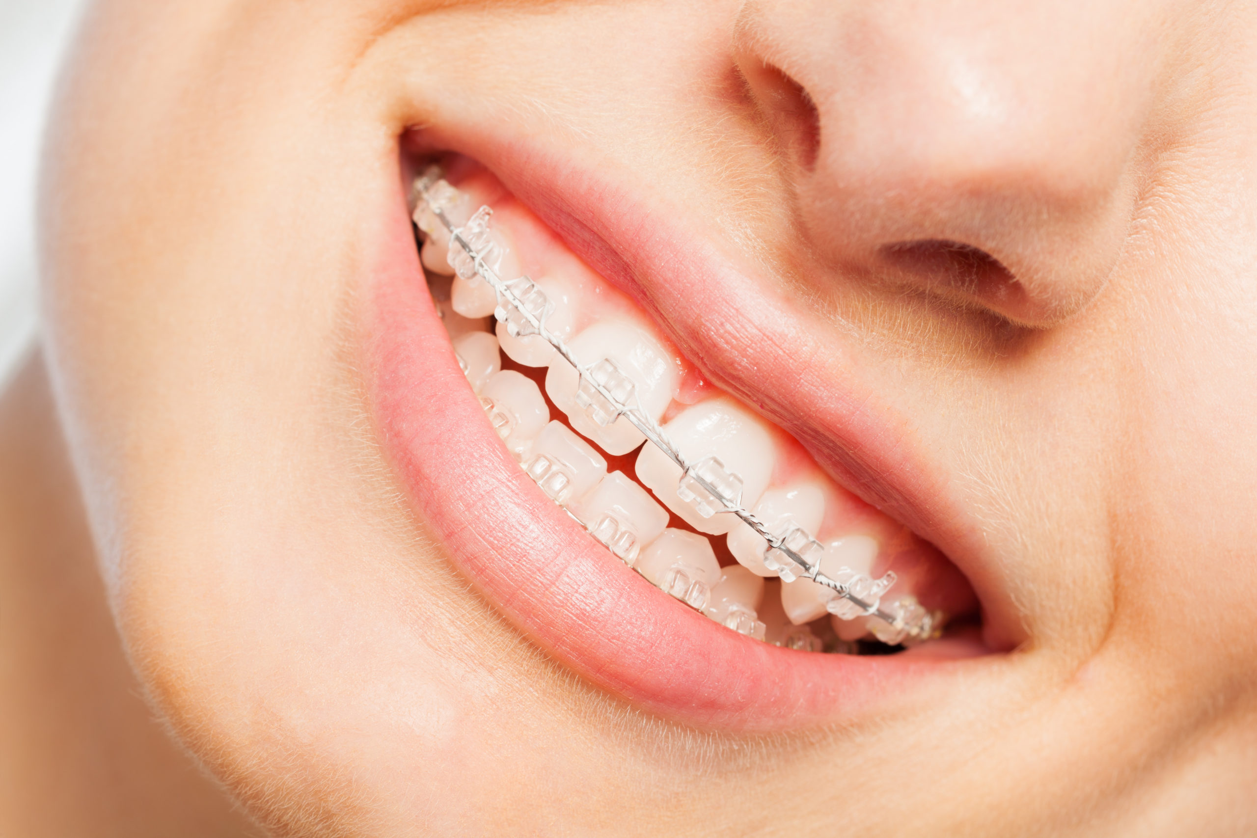 How Much do Braces Cost in 2022? (Metal, Lingual, Invisalign, Ceramic)