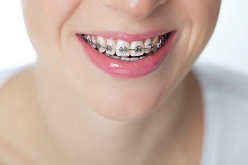 Image of woman's mouth smiling and wearing metal braces.