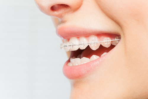 Sideview of woman's mouth smiling and wearing ceramic braces on teeth.