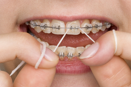 Image of a mouth with braces with the person flossing.
