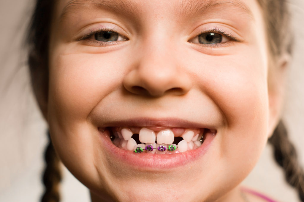 Young girl smiles to show partial orthodontic braces